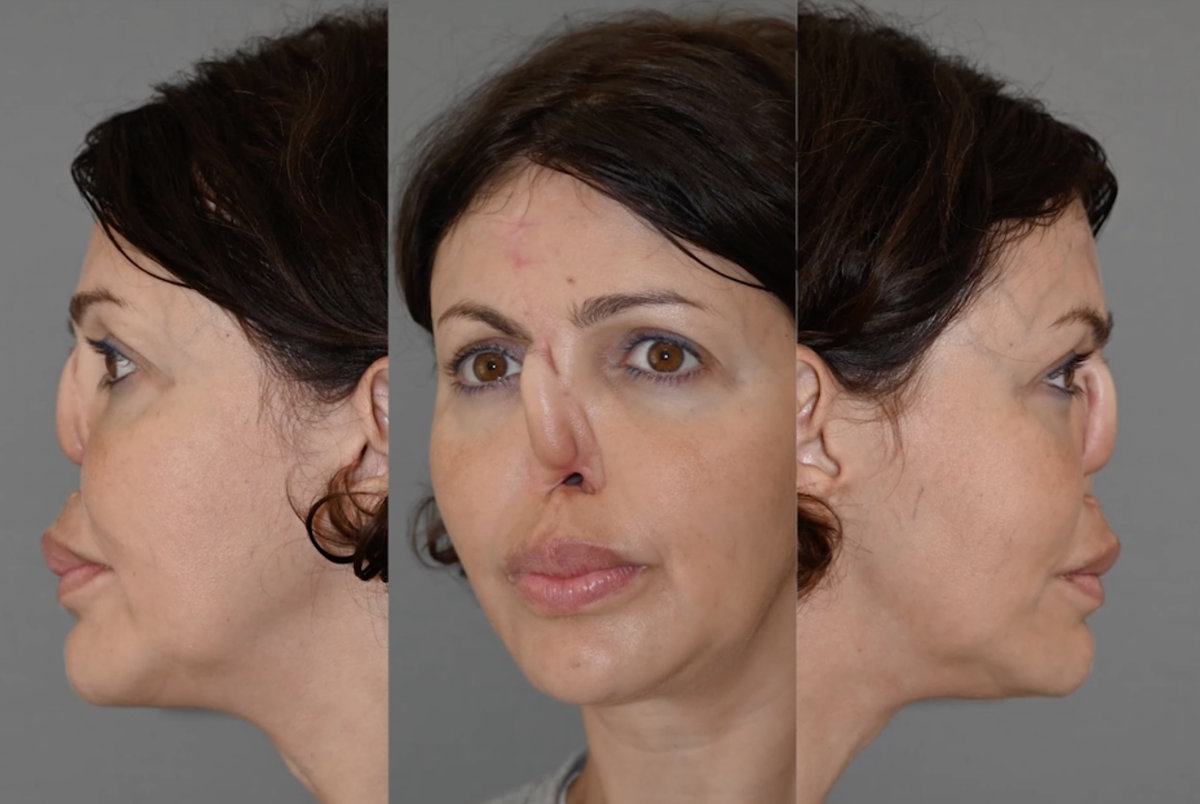 Проснулась без половины носа: кто стал героиней первого выпуска шоу «Что я наделала» на «Пятнице!»