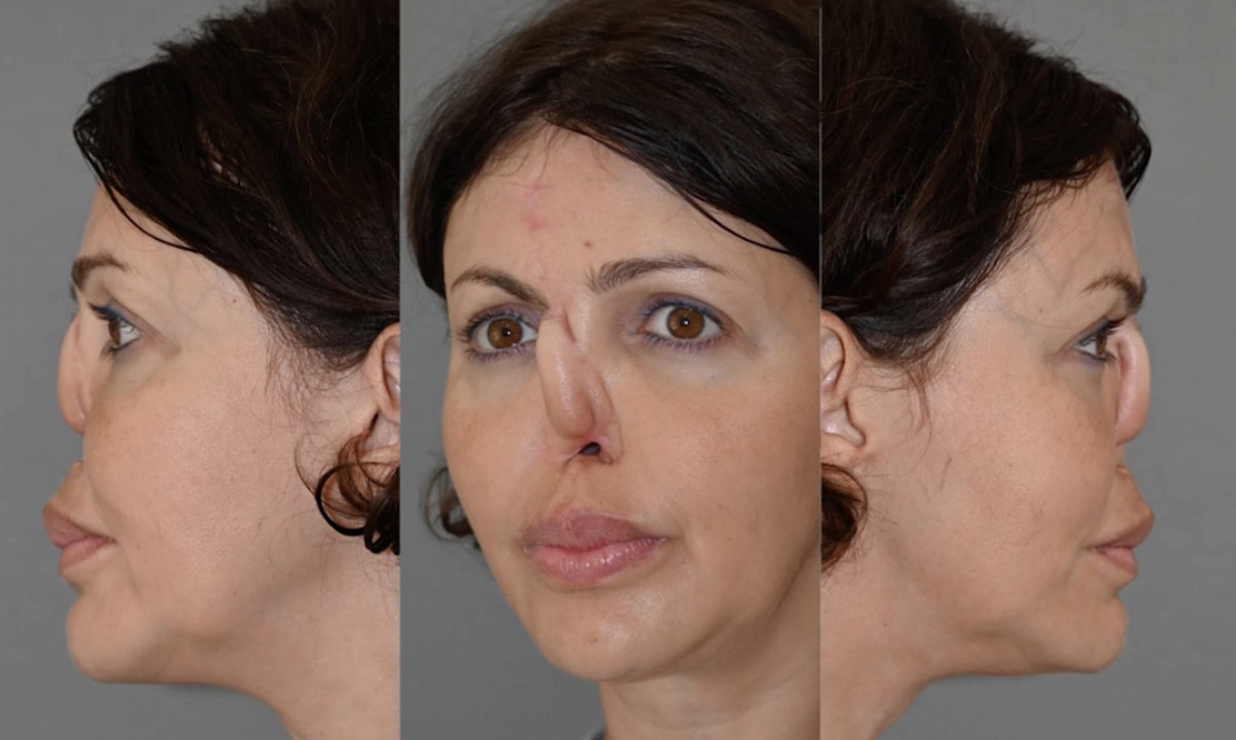 Проснулась без половины носа: кто стал героиней первого выпуска шоу «Что я наделала» на «Пятнице!»